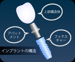 インプラントの構造